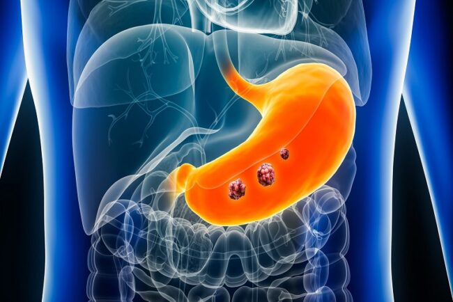 Stomach Cancer Surgery