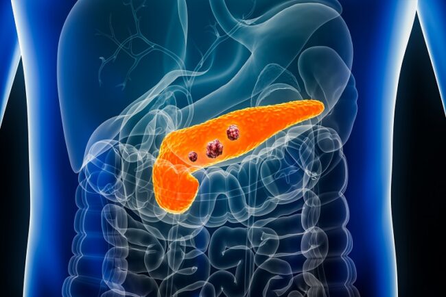 Pancreatic Diseases and Cancer Surgery